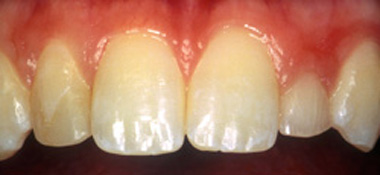 Close-up lips and teeth before teeth whitening photo of discolored, yellow teeth that were transformed by Baton Rouge cosmetic dentist Dr. Brooksher.