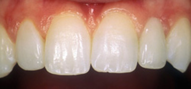 Close-up lips and teeth after teeth whitening photo of bright, white teeth that were transformed by Baton Rouge cosmetic dentist Dr. Brooksher.