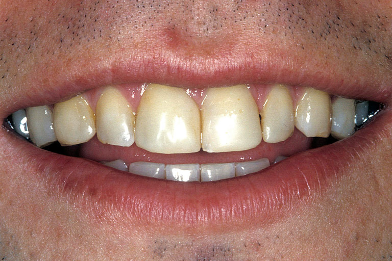 Closeup photo of Kurt smiling showing discoloration before smile makeover