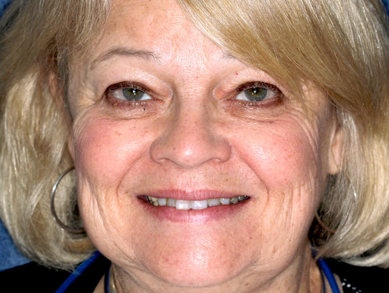Headshot photo of Caroly nsmiling showing worn yellow teeth before smile makeover