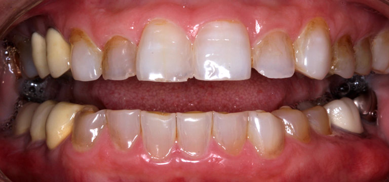 Closeup photo of Carolyn smiling showing worn yellow teeth before smile makeover