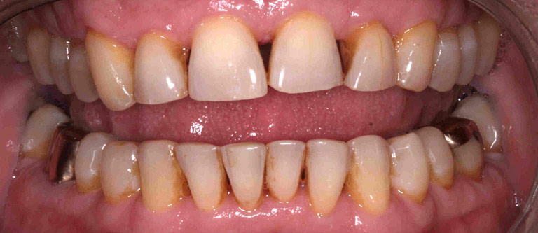 Closeup photo of Jim smiling showing gapped yellow teeth before smile makeover