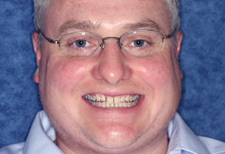 Headshot photo of Keith smiling showing gapped discolored teeth before smile makeover