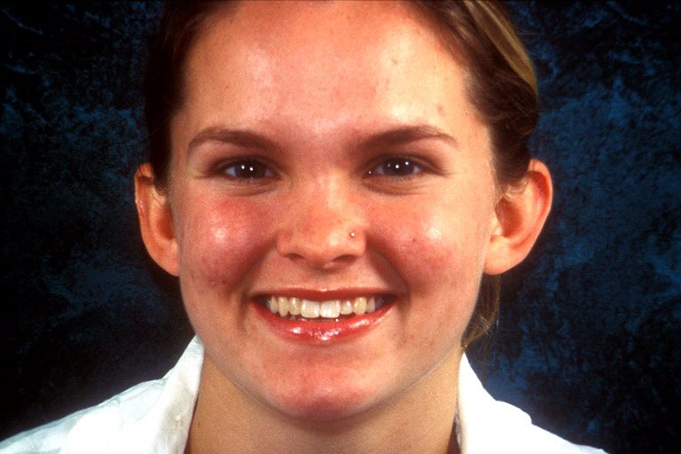 Headshot photo of Lindsay smiling showing worn discolored teeth before smile makeover