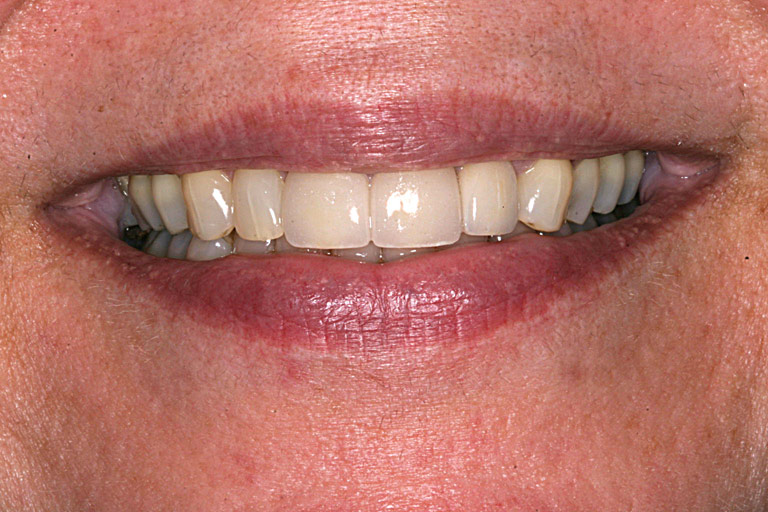Closeup photo of Liz smiling showing his smile makeover