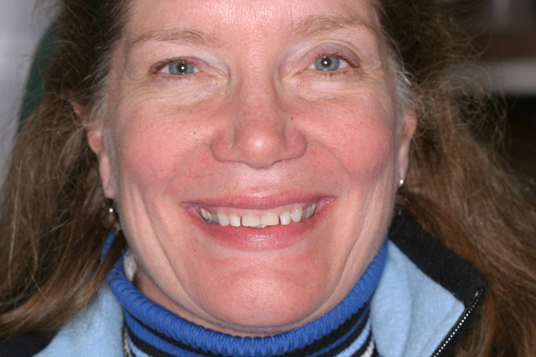Headshot photo of Robbie smiling showing severely worn discolored teeth before smile makeover