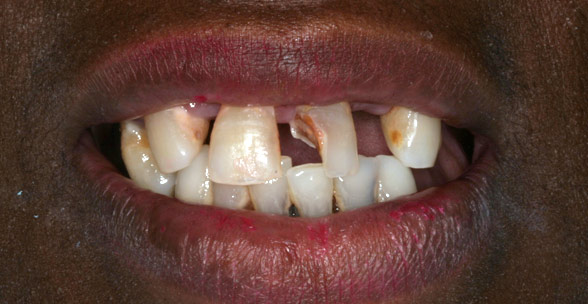 Closeup photo of Tracy smiling showing missing, decayed teeth before smile makeover