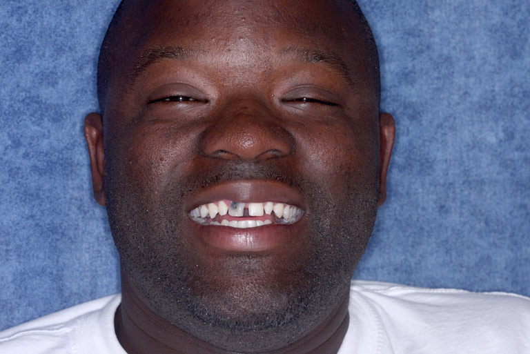 Headshot photo of Travis smiling showing gapped teeth width black front tooth before smile makeover