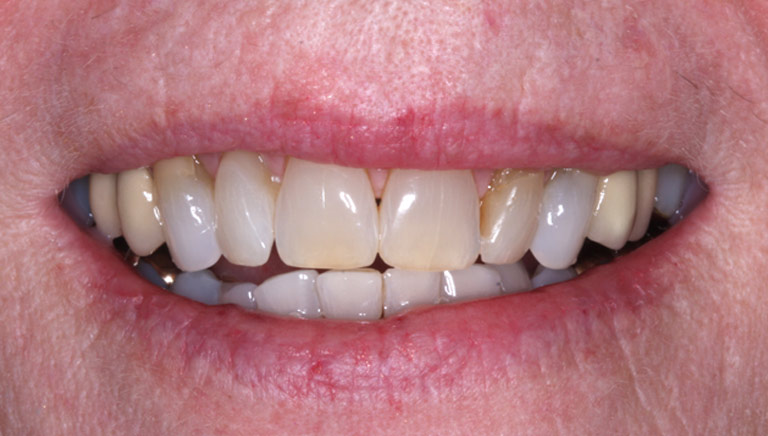 Closeup photo of Tara smiling showing severely worn discolored teeth before smile makeover