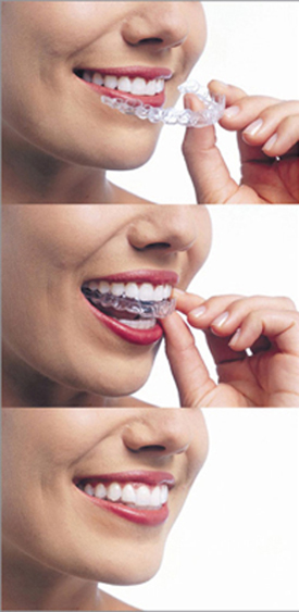 Three verticle photos of a woman progressivly putting Invisalign trays on her teeth.