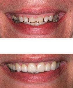 Incredible Smile Makeover With Gum Contouring & Veneers