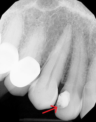 X-ray of an invisor tooth with a filling and a dark spot beneath it