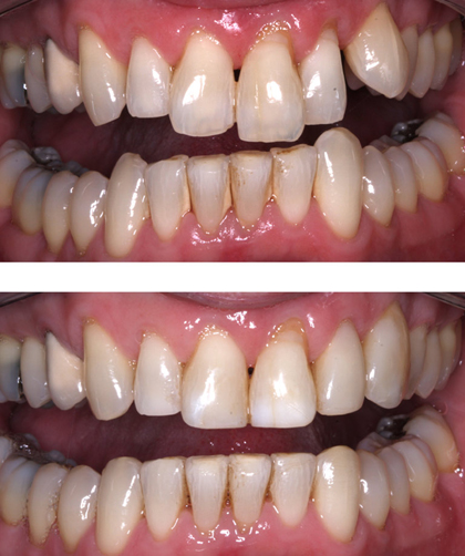 Dental bonding smile makeover before and after photos from Steven Brooksher, DDS of Baton Rouge, LA