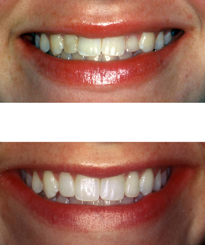 Before and after cosmetic dentistry photos from Steven Brooksher, DDS of Baton Rouge