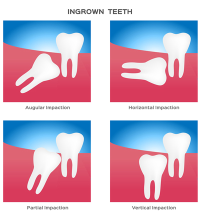 Four diagrams of impacted wisdom teeth that require sedation dentistry