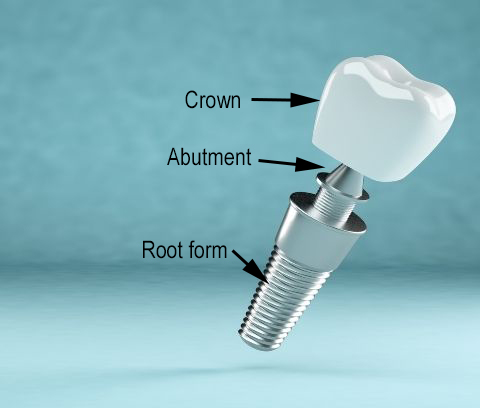 Dental implant components, including root form, abutment, and crown