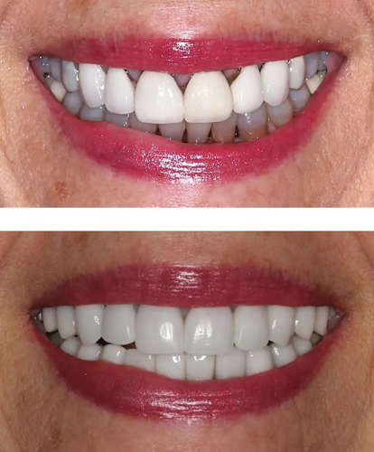 Before-and-after smile makeover from Dr. Steven Brooker of Baton Rouge