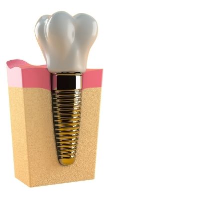 Dental implant model with the fixture in the bone