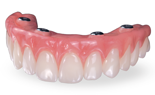 Palateless upper denture prepared for dental implants