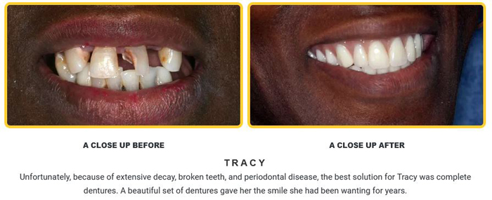Before and after dentures pictures from Baton Rouge cosmetic dentist Dr. Brooksher.