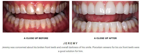 Before and after porcelain veneers pictures from Baton Rouge accredited cosmetic dentist Dr. Brooker