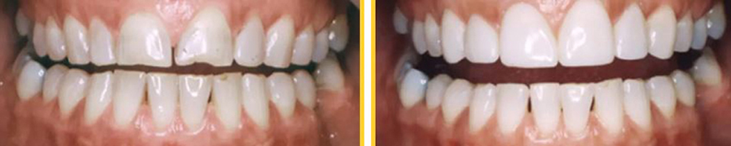 Before and after pictures of small adult teeth that look larger with dental bonding