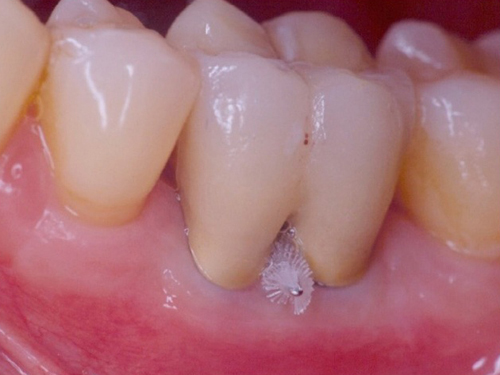 Tooth furcation with an interdental brush in the furcation for cleaning