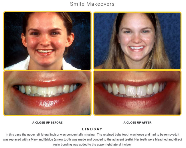 Before and after peg lateral cosmetic dentistry photos from Baton Rouge accredited cosmetic dentist Dr. Steven Brooksher