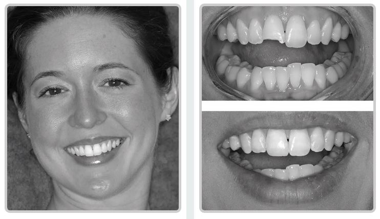 Before and after dental bonding pictures from Baton Rouge cosmetic dentist Dr. Steven Brooksher