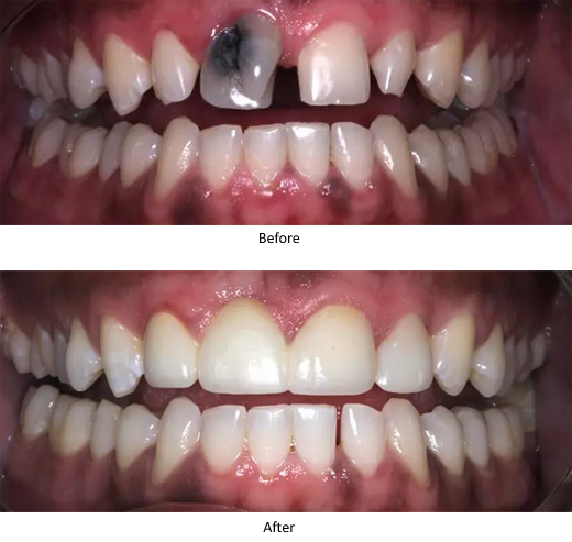 Before and after dark teeth picture
