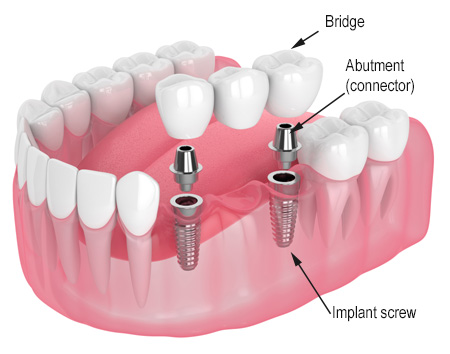 A dental bridge hovering above dental implants and abutments