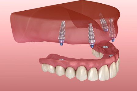 A drawing of an upper jaw with four implants in it, with replacement teeth and gums about to be screwed on.