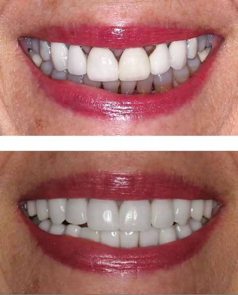 Dental crowns before and after photos from Baton Rouge dentist Dr. Brooksher