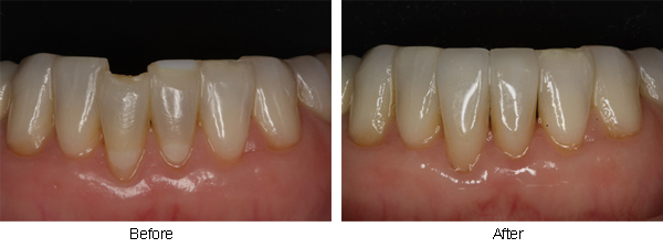 Chipped lower incisor before and after photos