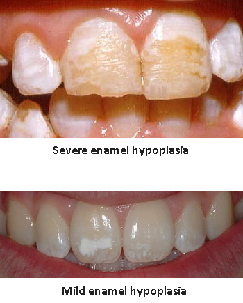 Teeth affected by severe enamel hypoplasia (upper) and mild enamel hypoplasia (lower)